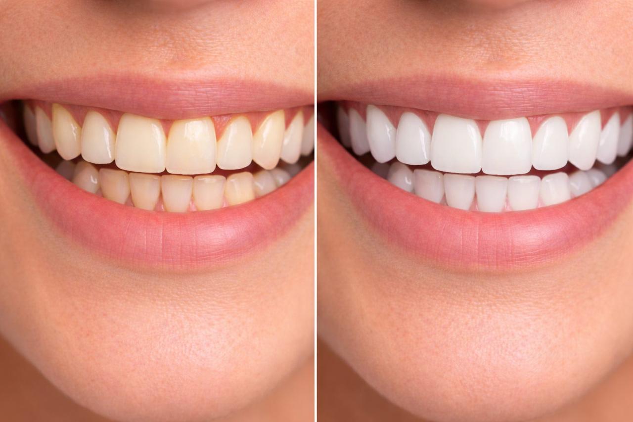 Veneer transformation