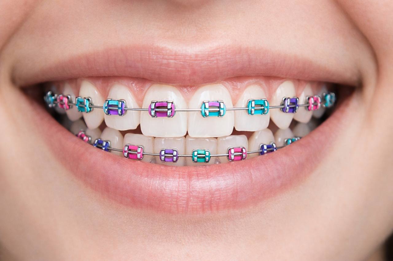 Pick your braces colors
